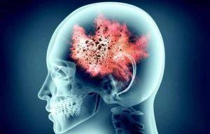 全球1/3人腦中有寄生蟲？研究揭人體免疫自毀開關