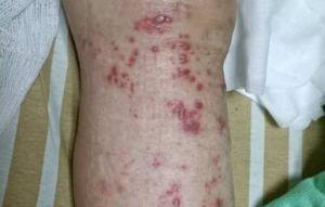 腳痛劇烈看骨科仍沒用 醫揪這病毒擴散是真凶