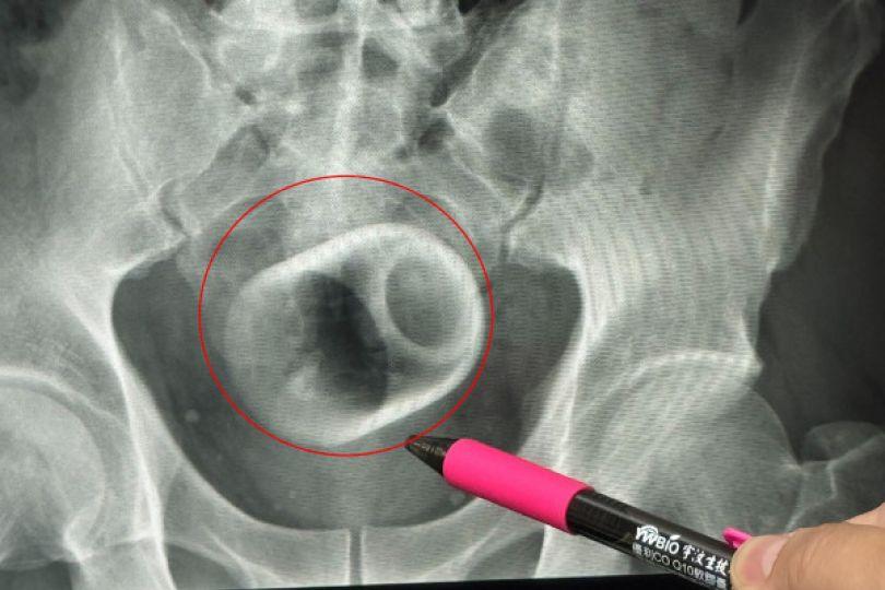 大叔瓷杯塞菊花難解便 破肚開腸取出