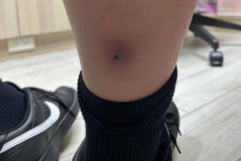 12歲童虛弱又喊腳痛 醫直覺：死亡級感染