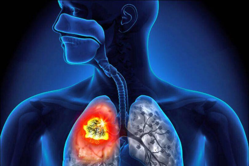 不吸菸年輕人肺癌增！高蔬果攝取者確診率偏高