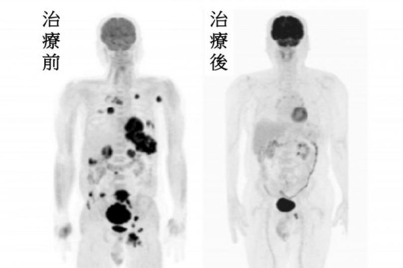 黑色素癌末已買好壽衣 他卻靠免疫治療抗癌10年