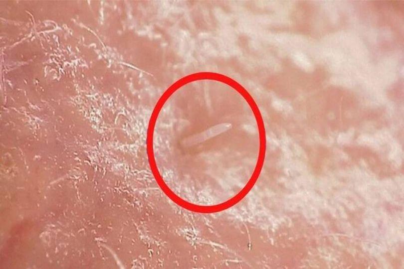 每個人臉上都有 研究揭毛孔蟎蟲正從寄生變共生