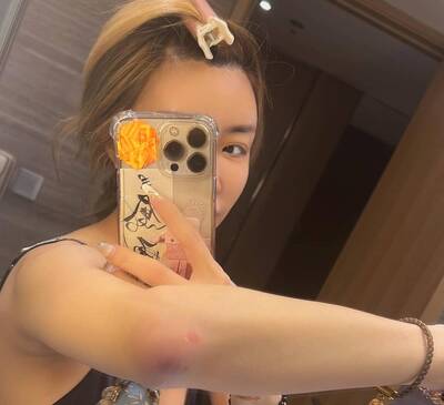 雪碧深夜驚傳浴室滑倒  最新傷勢曝光