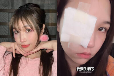 （影）網紅Ashly險失明 就醫驚爆「眼角膜破洞」
