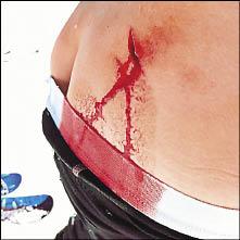 阿諾史瓦辛格的大兒子派翠克自Po鮮血直流的股溝傷口照，引爆網友熱烈討論。（取自推特）