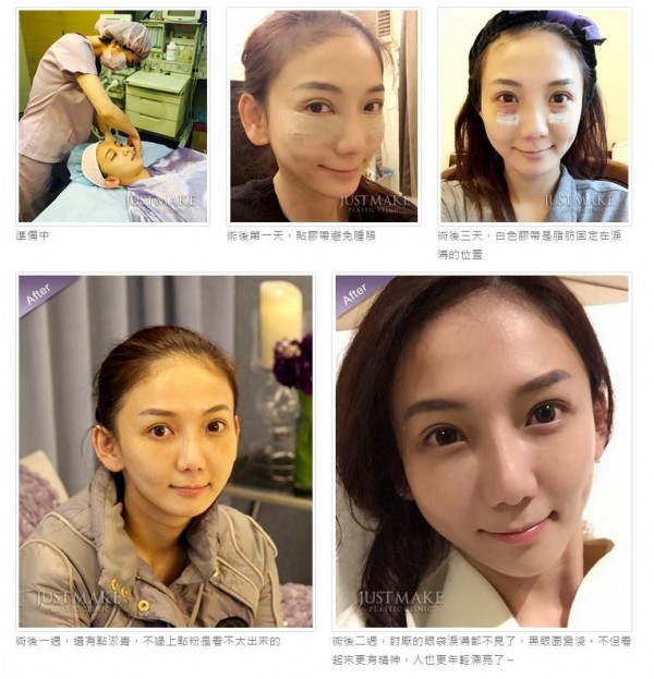 劉喬安事後受訪僅回:「和李進良是朋友。」但沒透露為何同意用「pretty tired(超累)」做宣傳。(圖擷取自嘉仕美整型診所) 劉喬安事後受訪僅回:「和李進良是朋友。」但沒透露為何同意用「pretty tired(超累)」做宣傳。(圖擷取自嘉仕美整型診所)