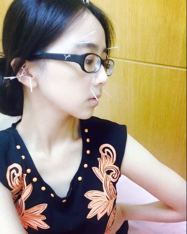 魏暉倪坦承身體出現狀況,日前還在臉書貼出接受針灸的照片。(翻攝自魏暉倪臉書) 魏暉倪坦承身體出現狀況,日前還在臉書貼出接受針灸的照片。(翻攝自魏暉倪臉書)