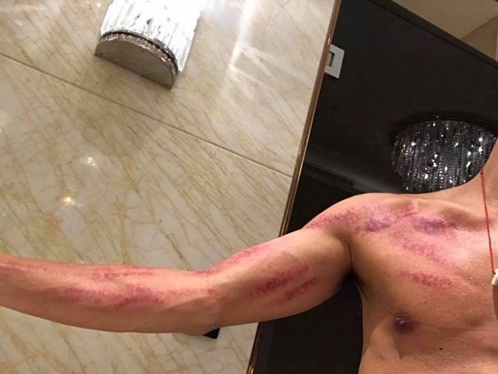 謝霆鋒秀出結實的健壯身材，但卻因為長時間待在廚房，而出現一條條血紅刮痧。（翻攝自謝霆鋒臉書）