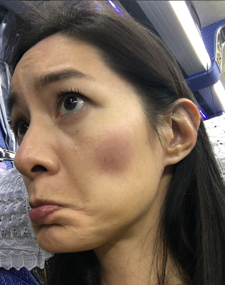 Janet臉部瘀青。(圖擷取自Janet IG) Janet臉部瘀青。(圖擷取自Janet IG)