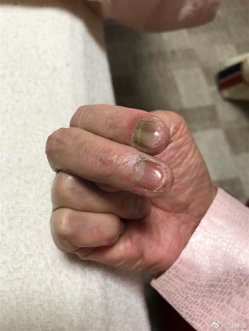 「金手指」過勞整組壞瞭瞭 60歲加藤鷹慘況曝光