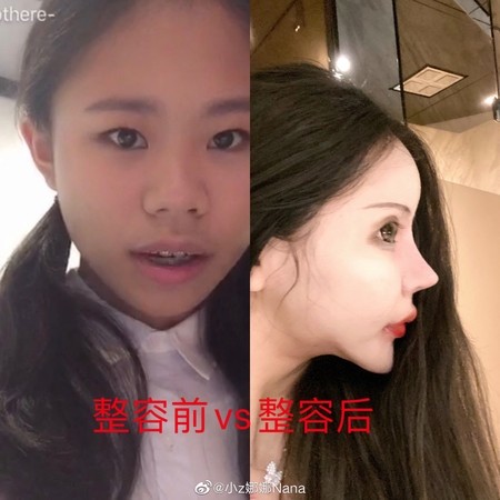 16歲網紅狂整形現況曝光網嚇傻 毛骨悚然 自由娛樂