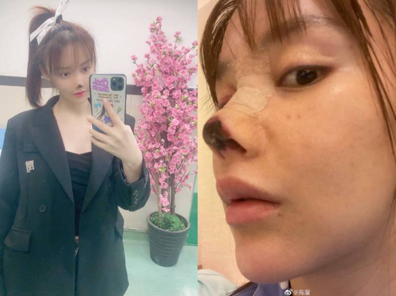 25歲女星整形失敗 鼻子壞死 開罰結果出爐惹議 自由娛樂 25歲女星整形失敗 鼻子壞死 開罰結果出爐惹議 自由娛樂