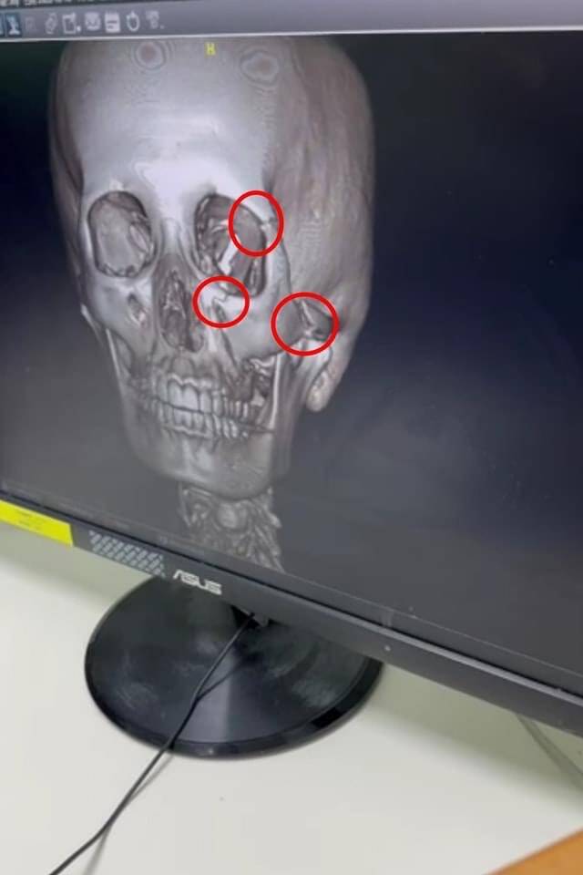 華視主播宋燕旻車禍傷勢曝光。(翻攝臉書)