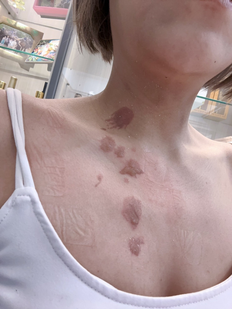 丟丟妹傷勢曝光。（樓頂揪樓下提供）