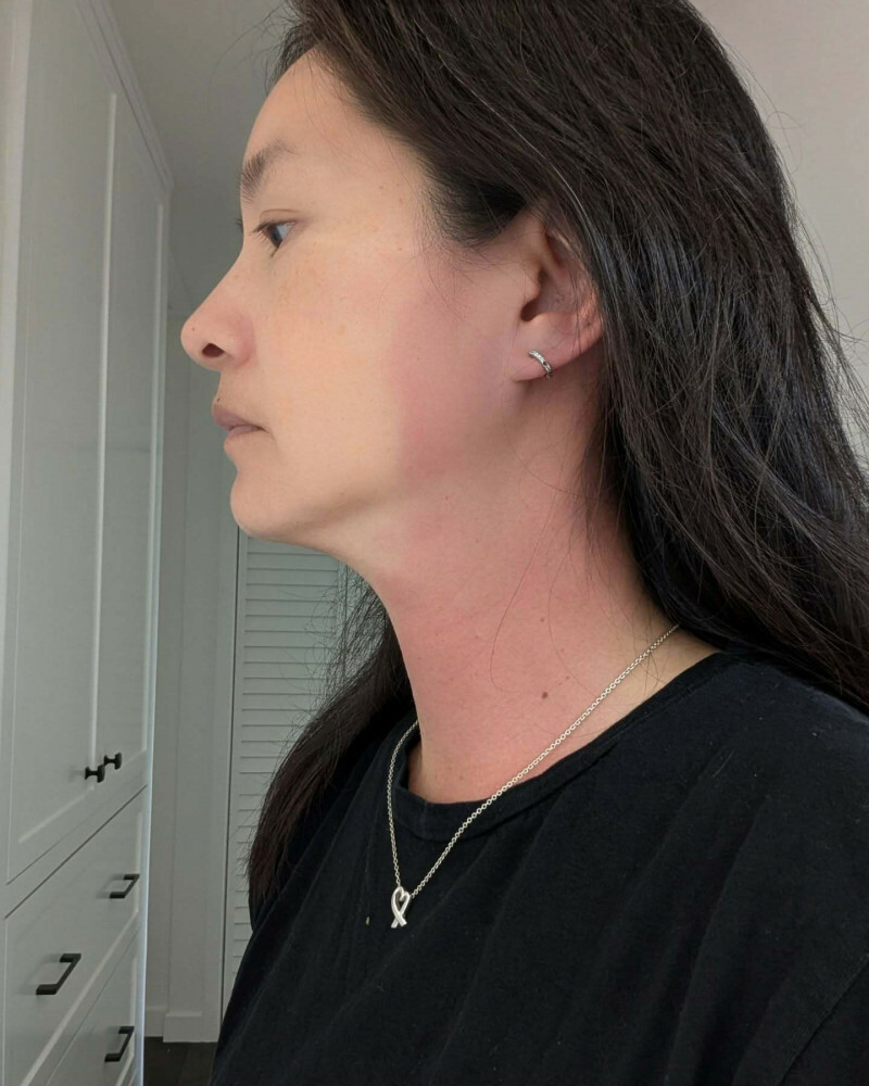 Janet今年6月在下巴、脖子出現不明紅腫，就醫查不出病因。（翻攝自臉書）