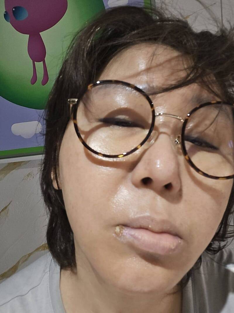 她自曝嘴邊長了臭嘴角。（翻攝自藍心湄臉書）