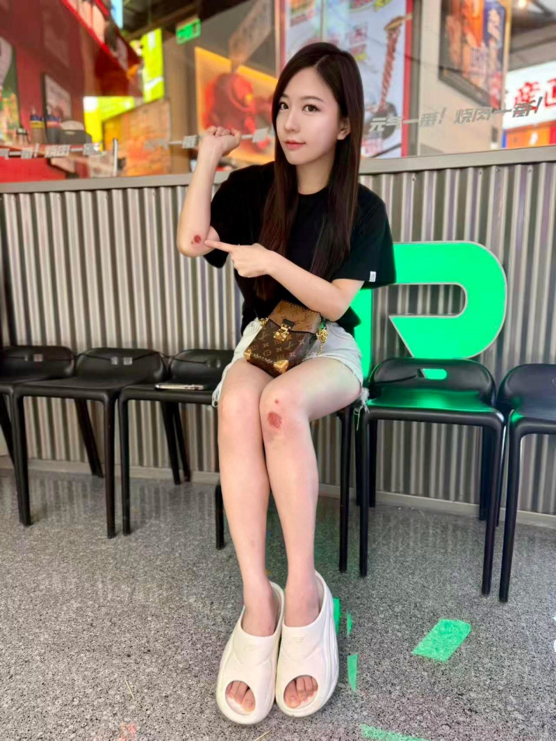 蔡尚樺驚傳濺血!奔跑失衡「下巴重撞地板」滿身傷照曝光