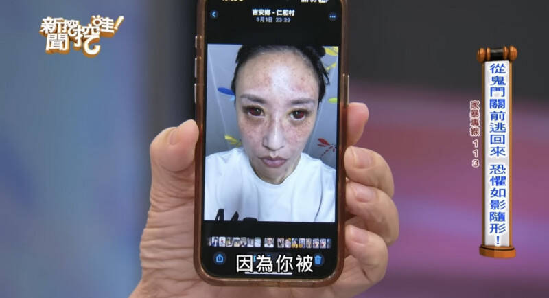 安歆澐遭家暴臉部微血管爆裂、雙眼血紅。（翻攝自YouTube）