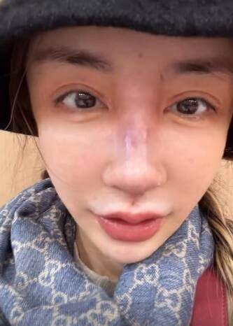 雪碧大方公開整鼻。（翻攝自雪碧IG）