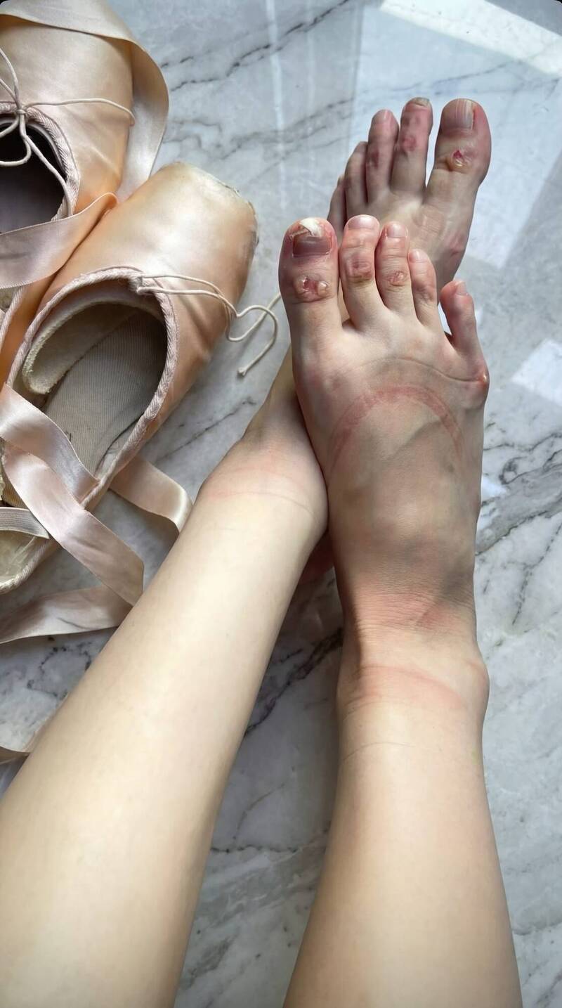 李元玲曬出自己因練習芭蕾舞傷痕累累的雙腳。（翻攝自Threads）