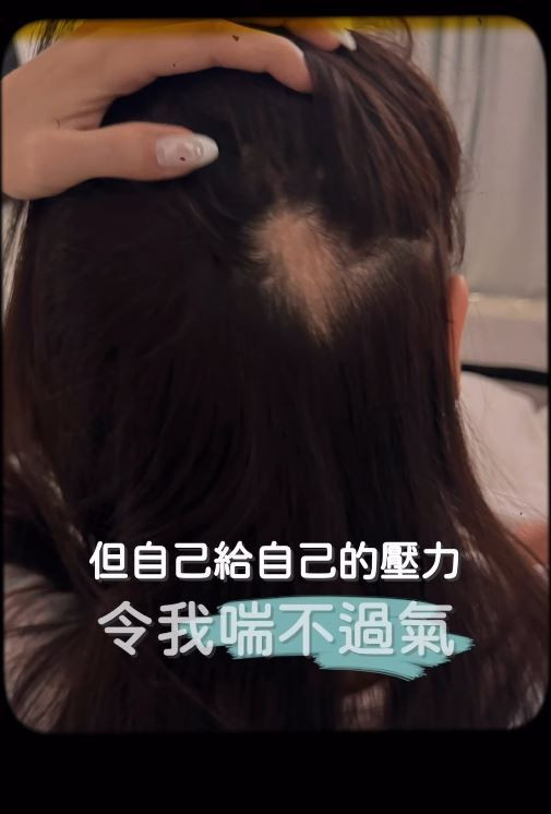 譚嘉儀分享求子過程，一度出現鬼剃頭。（圖／翻攝vivivvtam IG）