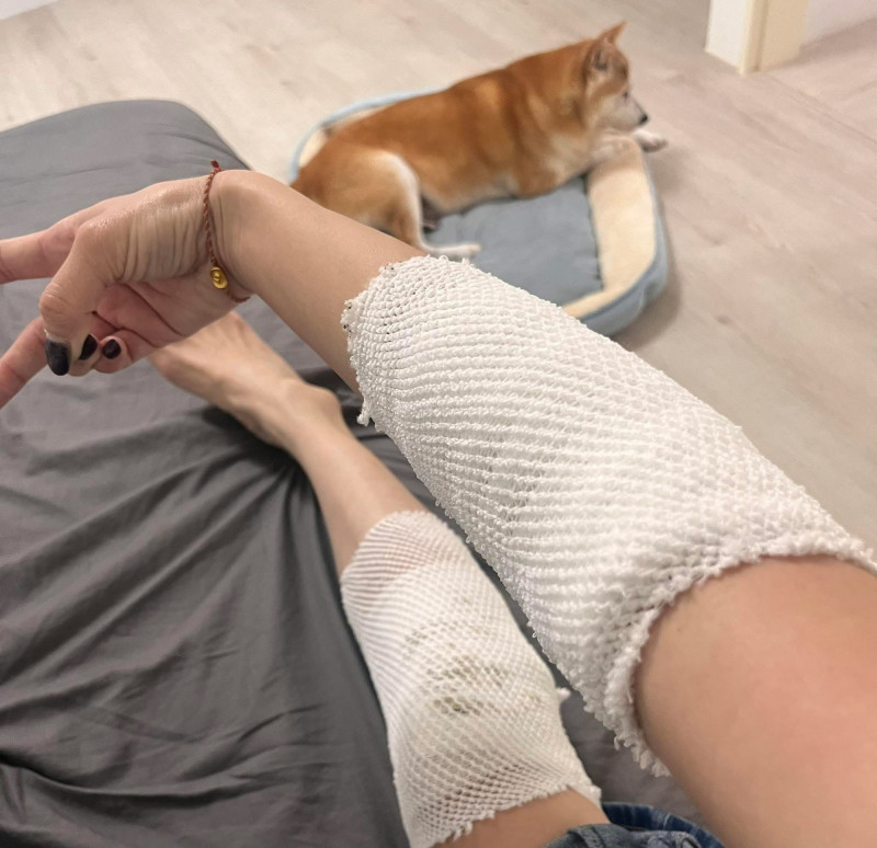 胡嘉愛分享繃帶照，自曝遇驚險一瞬間。（翻攝自臉書）