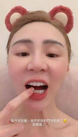 短今崩潰自己把門牙吃掉了。（翻攝自IG）