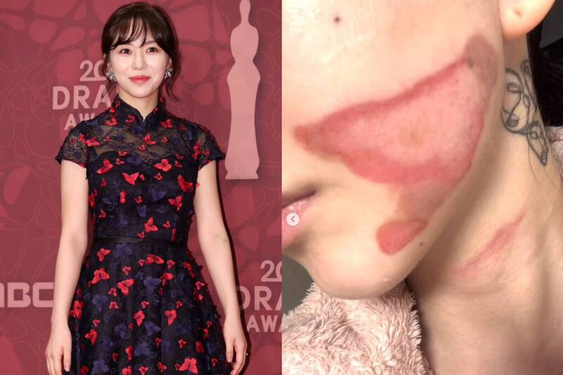 醫美出事一個月秒復出！AOA珉娥轉職皮膚科「壓力」全說了