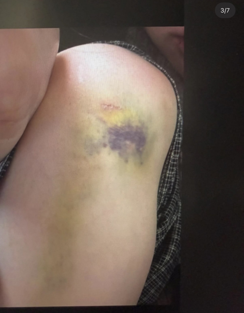 JISOO親哥疑似家暴老婆，傷痕累累。（翻攝自theqoo）