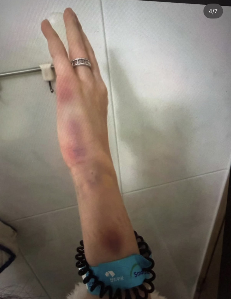 JISOO親哥疑似家暴老婆，傷痕累累。（翻攝自theqoo）