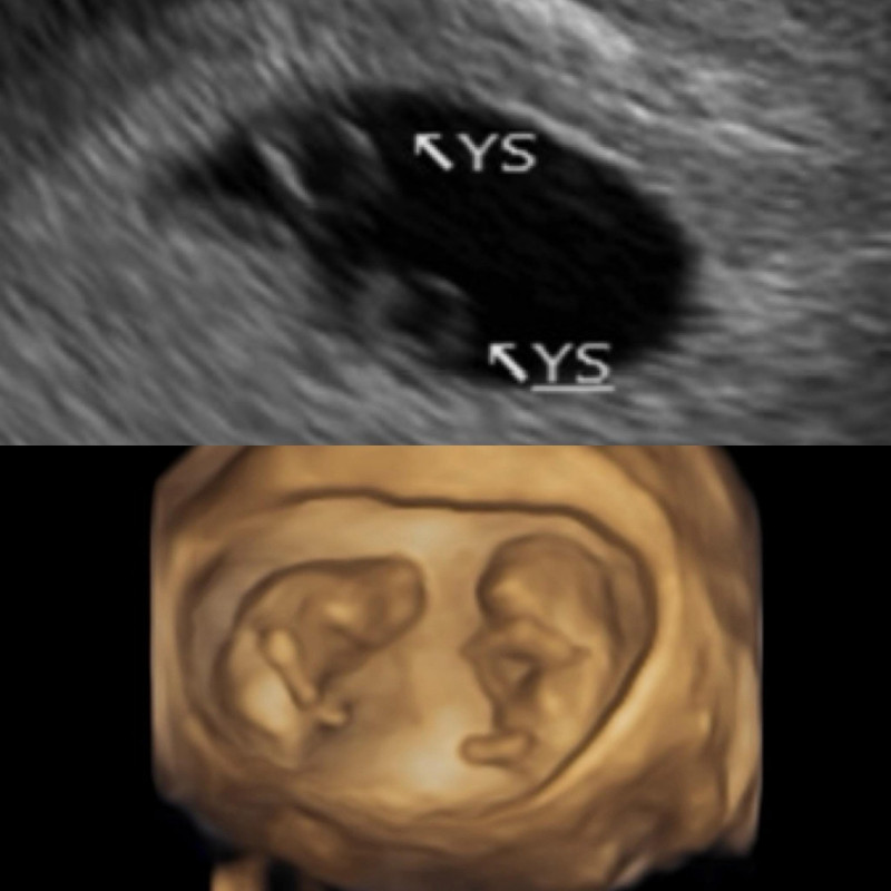 鄭家純曬超音波照，自然受孕「同卵雙胞胎」。（翻攝自臉書）