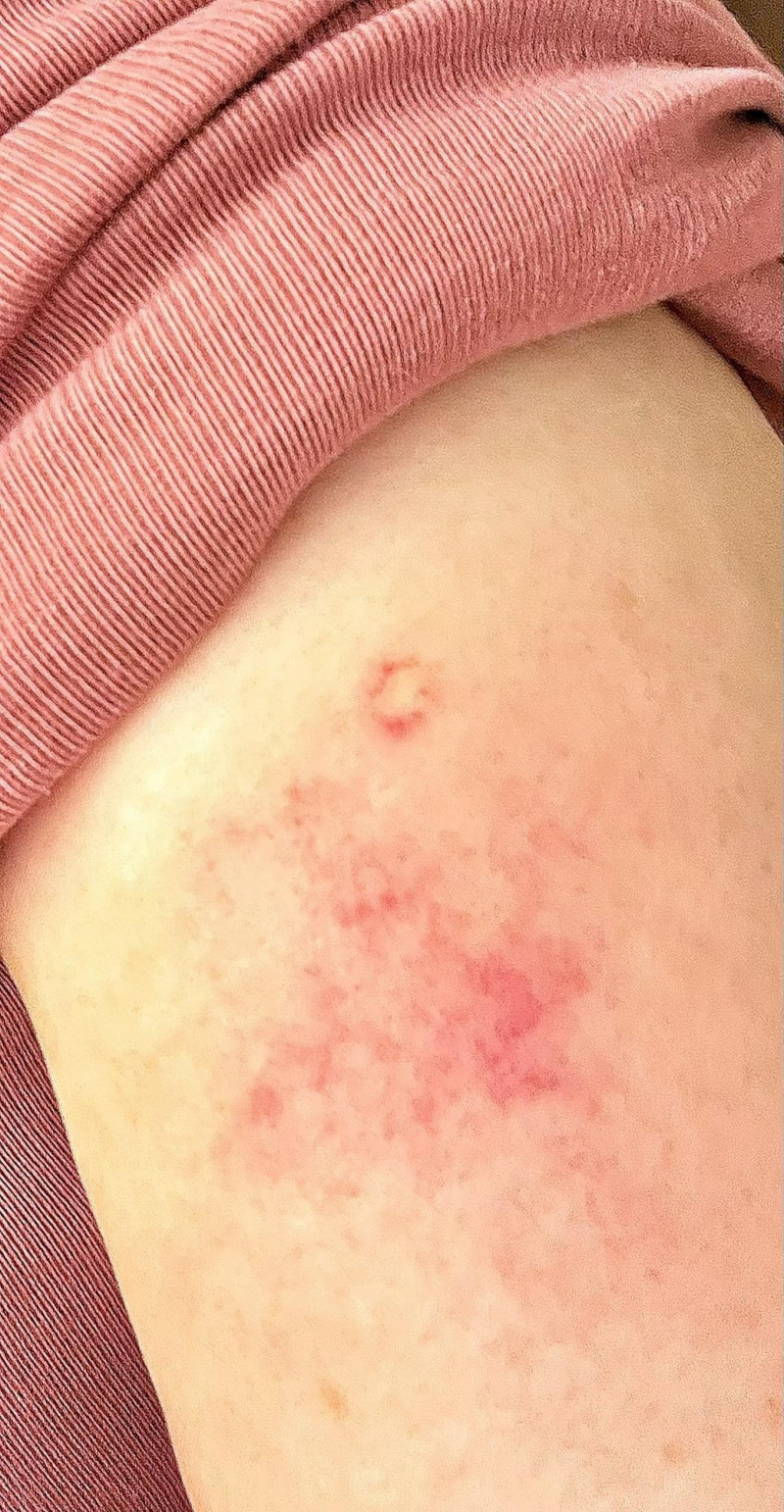 利菁秀出自己被虎頭蜂螫咬的紅腫傷口。（翻攝自臉書）