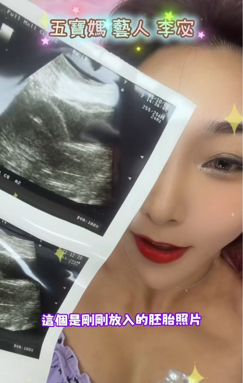 胚移植後の超音波写真を手にする李宓