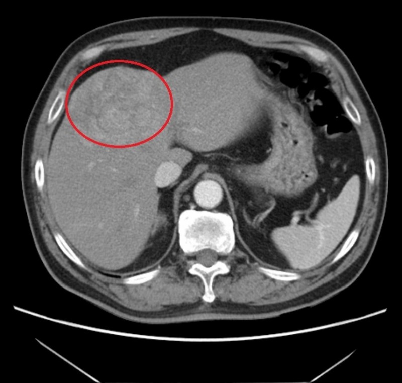 醫病》不知B肝帶原 一檢查竟發現肝腫瘤