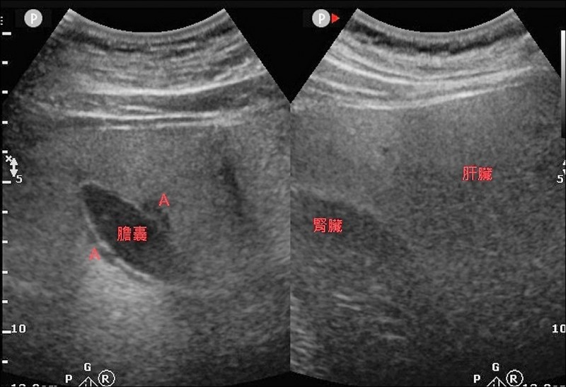 手搖飲、速食不忌口 小四生罹脂肪肝炎