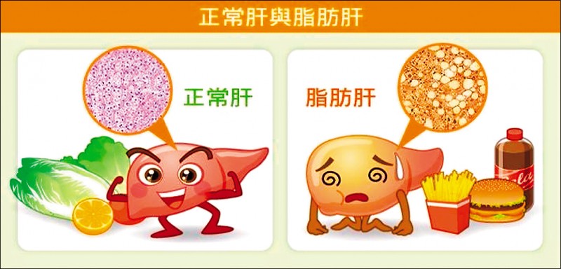 《愛肝加油站》變胖肝指數升高 可能是嚴重脂肪肝