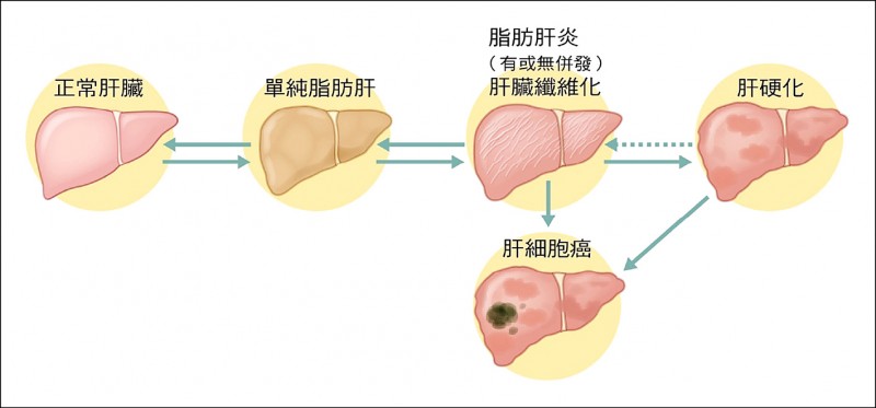 《愛肝加油站》嚴重脂肪肝併肝炎 久了恐形成肝硬化
