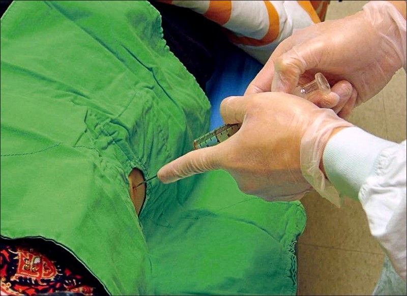 《愛肝加油站》要釐清肝硬化病因 唯有切片才能確知