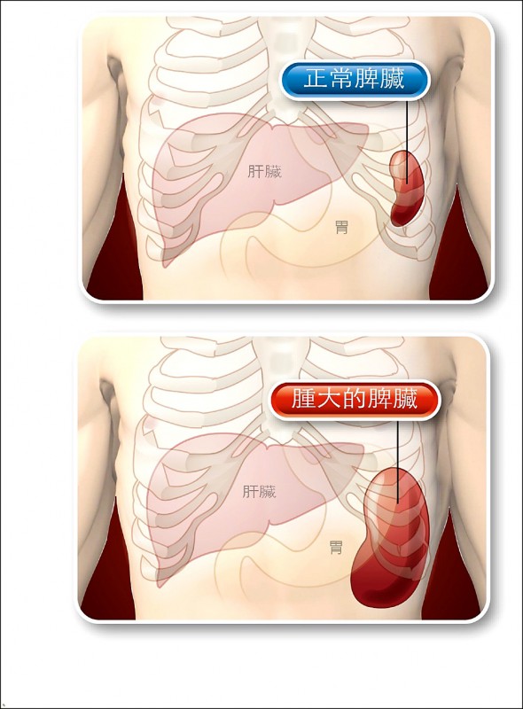 《愛肝加油站》肝硬化引發脾臟腫大 血小板都會偏低