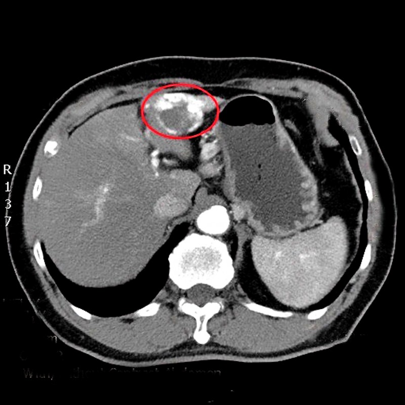 愛肝加油站》肝血管瘤內富含血液 穿刺檢查出血風險高