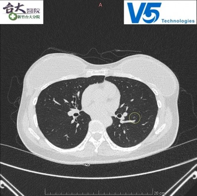 AI科技輔助肺部結節判讀 早期肺癌無所遁形