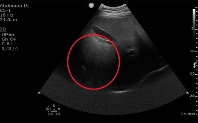 高一男愛吃速食體重近百 16歲罹脂肪肝嚇壞父母