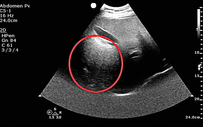 食量大、BMI32.5 16歲高一生驚罹脂肪肝