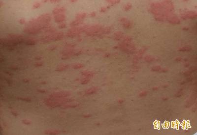 健康網》對抗擾人蕁麻疹 藥物治療搭良好生活習慣