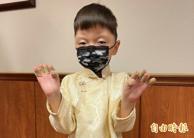蒙古5歲男童罹亞伯氏症 跨海來台手術興奮「有10根手指了」