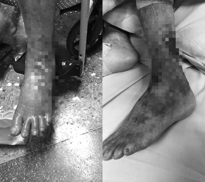 健康網》慎入！惡劣照服員燙傷9旬嬤沒處理 家屬發現送醫惡化病逝