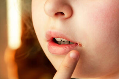 健康網》裂成「小丑微笑」！ 男童錯誤進補口角炎流膿血