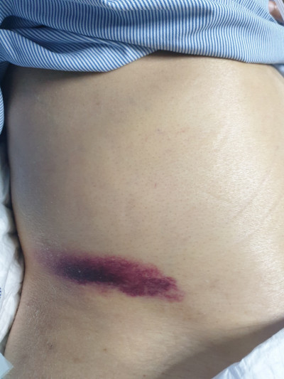 全球文獻首例 52歲男出現自發性腹股溝瘀青 最終病逝