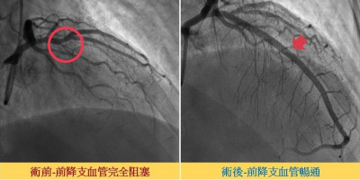 醫師胸悶胸痛3個月 心導管手術救回一命